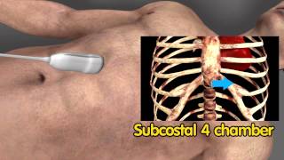 Echocardiographic view  Subcostal view  4 chamber [upl. by Sela220]