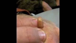 Man Squeezes Botfly from Hand [upl. by Raveaux]