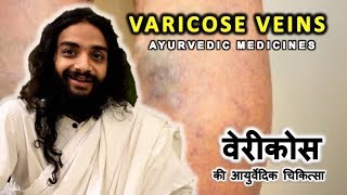 VARICOSE VEINS AYURVEDIC MEDICINE BY NITYANANDAM SHREE [upl. by Dimphia]