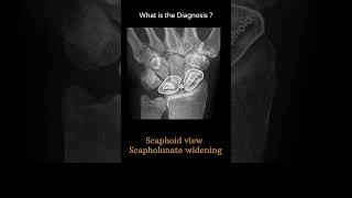 Scaphoid view  Scapholunate widening 146 Xray  Upper limb gallery 2radiologychannel007 [upl. by Ljoka651]