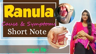 Ranula কী  plunging ranula  mucocele  treatment of RANULA  Etiology Clinical Features [upl. by Krenn]