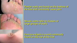 What are Foot Warts and How To Treat Them [upl. by Pippas]