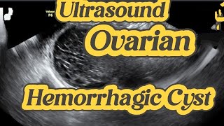 Ovarian Hemorrhagic Cyst  Adnexal Cyst  Cyst with internal Echoes  Pain irregular Bleeding [upl. by Enimisaj]