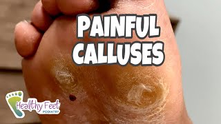 CALLUS REMOVAL AT HOME SO SATISFYING [upl. by Lladnek]