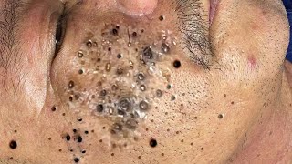 Big Cystic Acne Blackheads Extraction Blackheads amp Milia Whiteheads Removal Pimple Popping  65484 [upl. by Ritchie]