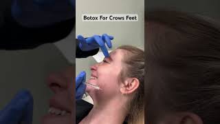 Botox For Crows Feet [upl. by Etty202]