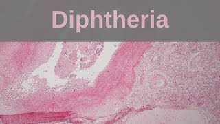 Diphtheria  Pathology mini tutorial [upl. by Ettenahc]