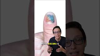 Hematoma Subungueal 💅😱 medicina medico curiosidades saude enfermeira enfermagem saúde [upl. by Marbut]