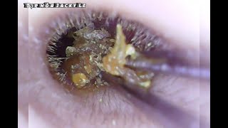 Ear Wax Removal 37  Clean Wet Earwax  Ear Cleaning ASMR [upl. by Enilekaj]