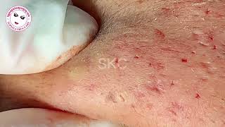 Acne facial removal treatment by Sopheaskincare 29th October 2023 [upl. by Ojiram]