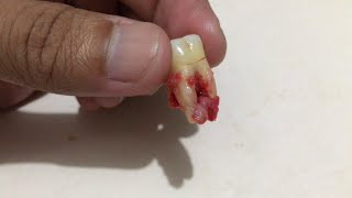 TOOTH amp GUM ABSCESS [upl. by Crelin]