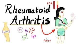 Rheumatoid Arthritis RA  Autoimmune Disease  Definition Etiologyamp Epidemiology  Rheumatology [upl. by Quartis]