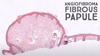 Angiofibroma fibrous papule clinical mimic of basal cell carcinoma pathology dermatology [upl. by Rentsch85]