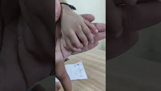 Polydactyly orthopedicshortcase pediatricorthopedics [upl. by Baum]