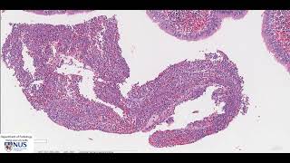 Lung Bronchiectasis Microscopy  Talking slide [upl. by Peper]