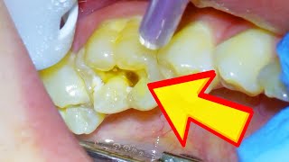 Dentist Shows How to Reverse a Cavity amp If It Is Possible That You Can Cure Tooth Decay Naturally [upl. by Shishko]