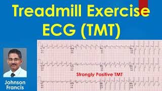 Treadmill Exercise ECG [upl. by Kinimod]