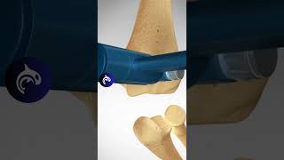 How does an Elbow Replacement work 3D Animation [upl. by Comras]