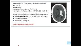 31  les anticoagulants oraux partie 4 [upl. by Enywad357]