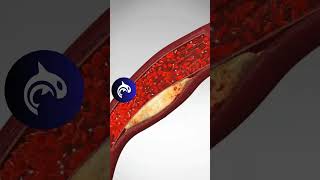 See what a Blood Clot looks like in your arteries  artery bloodclot heart [upl. by Ydor548]