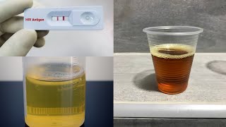 Can Urine color show if someone has HIV Urine test and HIV foamy cloudy urine English version [upl. by Malkin284]