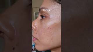 Tratamento para cicatriz de acne e manchas Peeling químico e microagulhamento [upl. by Center490]