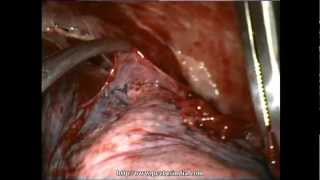 Thoracoscopy VATS Decortication in stage 2 empyema Delhi Noida India [upl. by Aznerol]