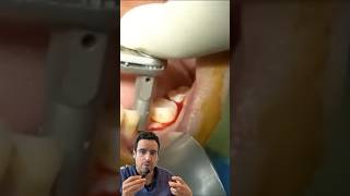 Cas Clinique  Pose IMPLANT DENTAIRE live [upl. by Daley]