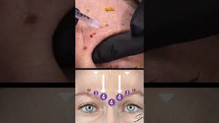 How to treat the Glabella in 30 seconds 💉 [upl. by Bandler]