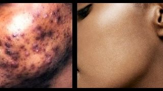 How to Remove Dark amp Black Spots on Face  Get Flawless Glowing Skin  superWOWstyle [upl. by Atekehs794]