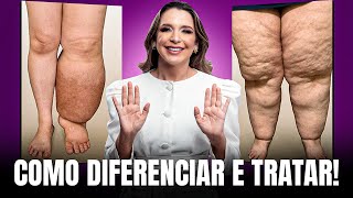 Lipedema x Linfedema Como Identificar E Tratar [upl. by Aled]