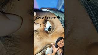 Wilson Disease  Kayser Fleischer Ring Pediatrics clincal case series [upl. by Gnart]