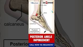 Struggling with persistent pain at the back of your ankle 🤔  physiotherapy ankleinjury [upl. by Lomasi945]