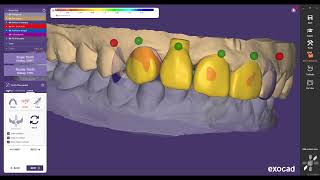 Zircon Coping Design in Exocad [upl. by Zuckerman451]