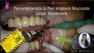 Peri Implantitis amp Peri Implant Mucositis Laser Treatment [upl. by Tihw]