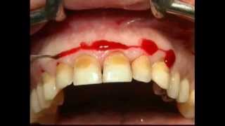 Gingival Surgery  External Bevel [upl. by Schaffer]