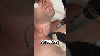 How Exactly Does Laser Tattoo Removal Actually Work 😳 [upl. by Netniuq]