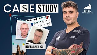 Case Studies Unveiled Dr Gökay Bilgins 4300 Grafts 9Month Hair Transplant Success Story [upl. by Enilrahc]