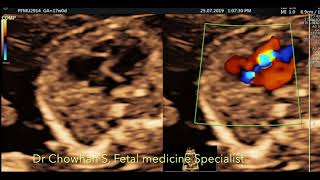 Ebsteins anomaly by Dr Chowhan S Fetal Medicine Specialist [upl. by Euqina]