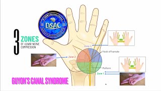 Three zones of ulnar nerve compression in Guyons canal Ulnar nerve entrapment neuropathy anatomy [upl. by Naryb]