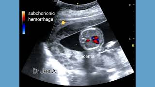 Subchorionic hemorrhage and hematoma in 2nd trimester pregnancy Ultrasound and color Doppler video [upl. by Alyak]