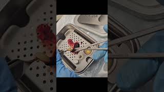 Socket preservation technique with bone graft and PRP amp PRF [upl. by Yehsa688]