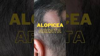 Alopecia Aerata homeopathic medicine  Hairfall homeopathic medicine  bal urr jana ka ilaj [upl. by Obla857]