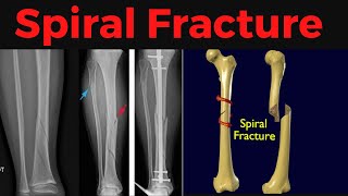 What is Spiral Fracture Spiral Fracture Symptoms Causes Treatment Xray [upl. by Ocirnor666]