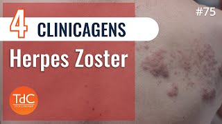 4 Clinicagens sobre Herpes Zoster  Episódio 75 [upl. by Dorey127]