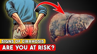 10 Early Signs of Cirrhosis  Are You at Risk [upl. by Arden]