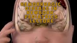 Hemorrhagic Disease In Newborn Pediactric Lecture [upl. by Shanon]