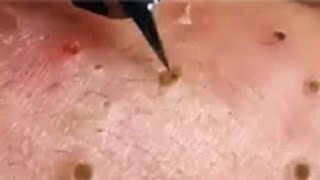 Full Giant Blackheads Popping Video Blackheads Removal 2019 [upl. by Aiem]