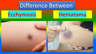 Difference between Ecchymosis and Hematoma [upl. by Margeaux646]