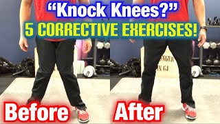 quotKnock Kneesquot Genu Valgum 5 BEST CORRECTIVE EXERCISES  Dr Wil amp Dr K [upl. by Dahlia]